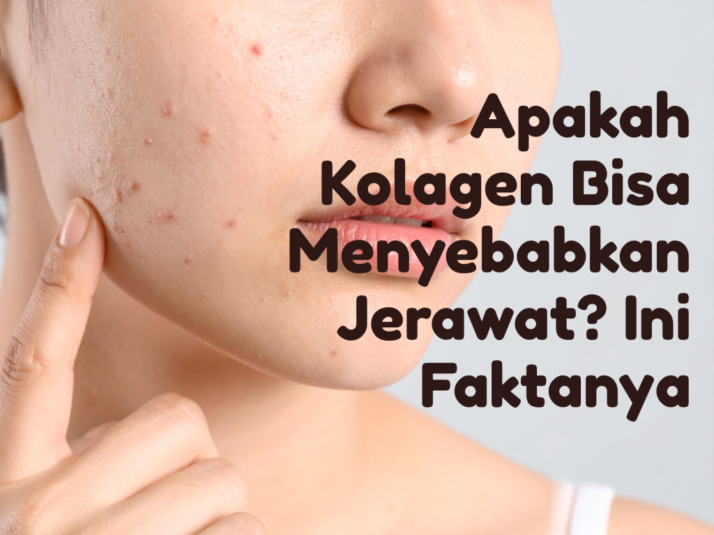 Apakah Kolagen Bisa Menyebabkan Jerawat? Ini Faktanya